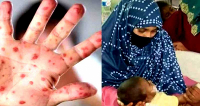 হামের উপসর্গে আরও ২ শিশুর প্রাণহানি