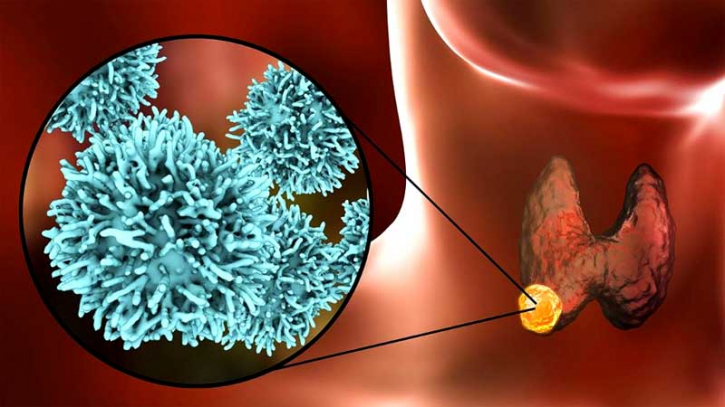 থাইরয়েড ক্যান্সারের ৭টি প্রাথমিক লক্ষণ জানুন