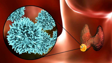 থাইরয়েড ক্যান্সারের ৭টি প্রাথমিক লক্ষণ জানুন